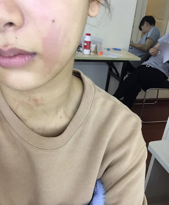 产后荨麻疹的症状图片