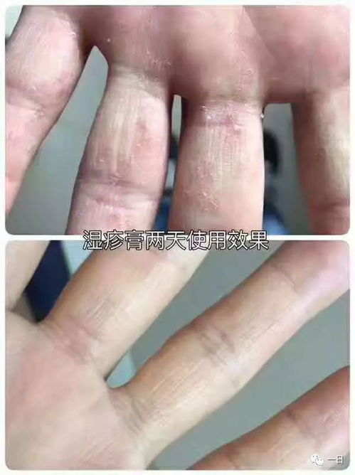 口碑 明星产品 蟾酥湿疹膏
