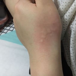 这种荨麻疹怎么治