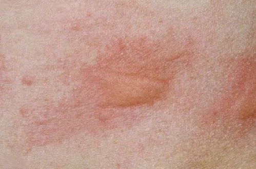 关于慢性荨麻疹的 6个常见认知误区