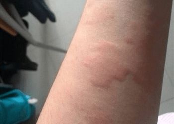 得了荨麻疹不要慌
