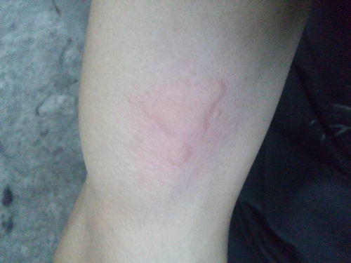 荨麻疹有治愈过得盆友给个方法,都好几天了吃药打针,还是复发