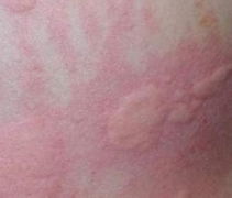 荨麻疹的治疗方法有哪些