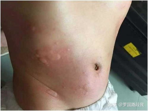得了荨麻疹是一种怎样的体验