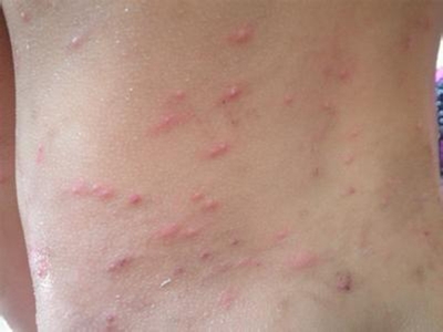 荨麻疹图片和症状 (35)