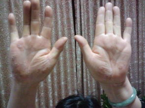 牛皮癣治疗方法大全,治疗5种选择