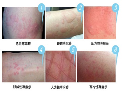 荨麻疹是一种常见的皮肤病是由于皮肤黏膜小血管扩张及渗透性.