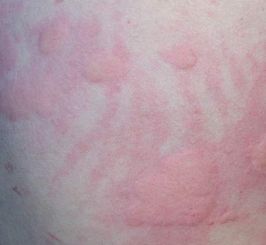 荨麻疹病开始症状