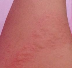 治荨麻疹除根的偏方有哪些