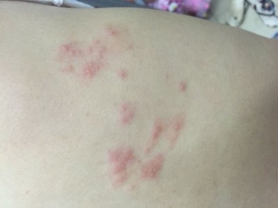 急性荨麻疹快好的症状