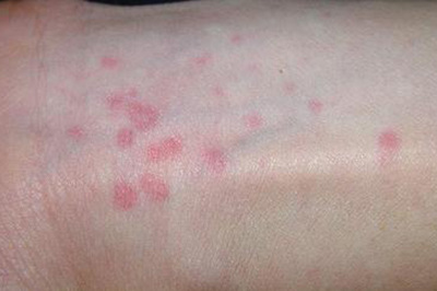 风团图片和症状图片