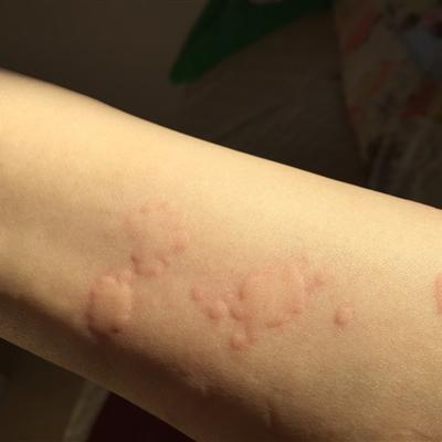 荨麻疹是怎么回事?