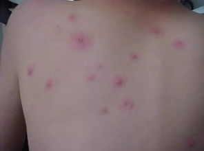 丘疹性荨麻疹和水痘的如何鉴别