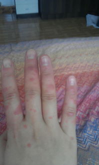 昨天去医院看了,医生说是丘疹性荨麻疹,昨晚吃了药,但是感觉疹子没有消停的迹象,怎么办