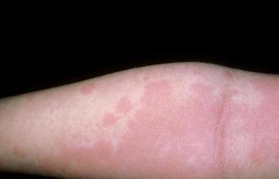 为什么荨麻疹总是反复发作?这6点或是“幕后黑手”