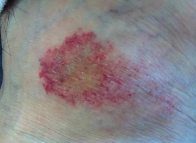 图文盘点 肢端分布的血管性皮肤病