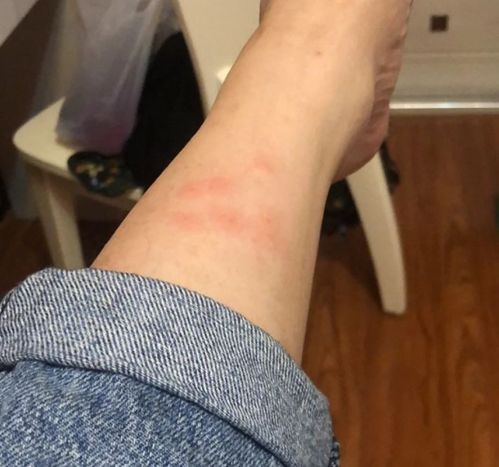 湿疹图片初期症状图片 告诉你一个缓解湿疹的好方案