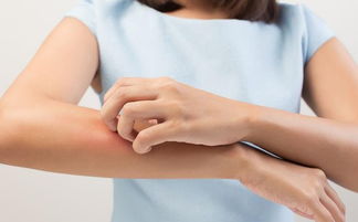 秋季荨麻疹来势快,想赶走它,需要坚持每天三件事