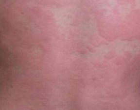 治疗孕妇荨麻疹小偏方