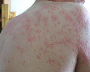 1个简单方子,将荨麻疹杀光光,很多人用,5年荨麻疹治好了