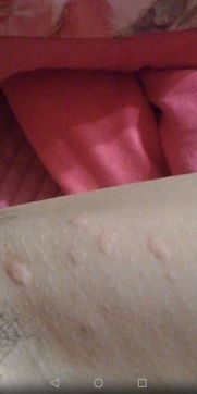 荨麻疹怎么治疗