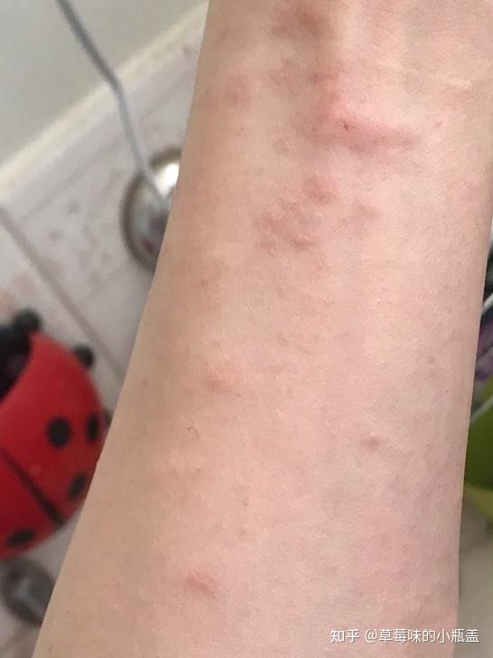 针对湿疹有什么好的法子