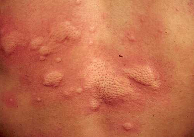 产后荨麻疹的症状图片