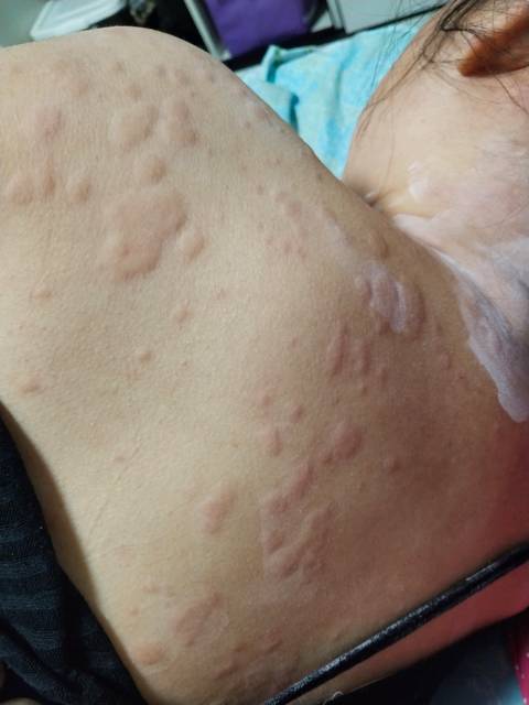 ,急性荨麻疹求止痒方法。