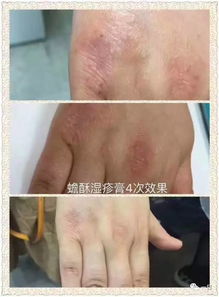 口碑 明星产品 蟾酥湿疹膏