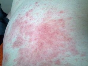 激素依赖性皮炎治疗后总是反复发作,可怕