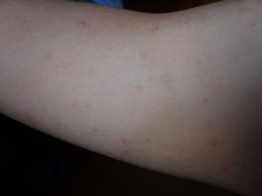 这是荨麻疹吗 还是 什么别的 我现在张了一身 难受死了 帮帮忙 谢谢