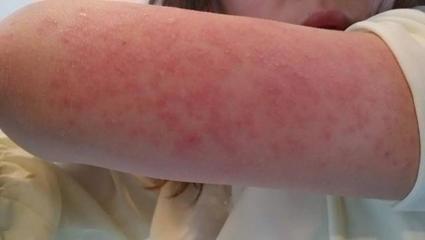 秋季,荨麻疹高发季,增强免疫为原则,通调肺脾为