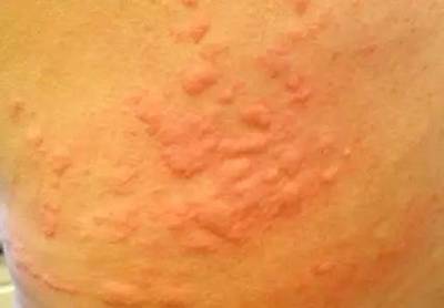 越痒越搔越痒 荨麻疹の药物击破攻略