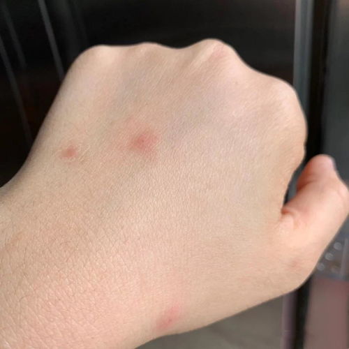 如何治疗丘疹性荨麻疹