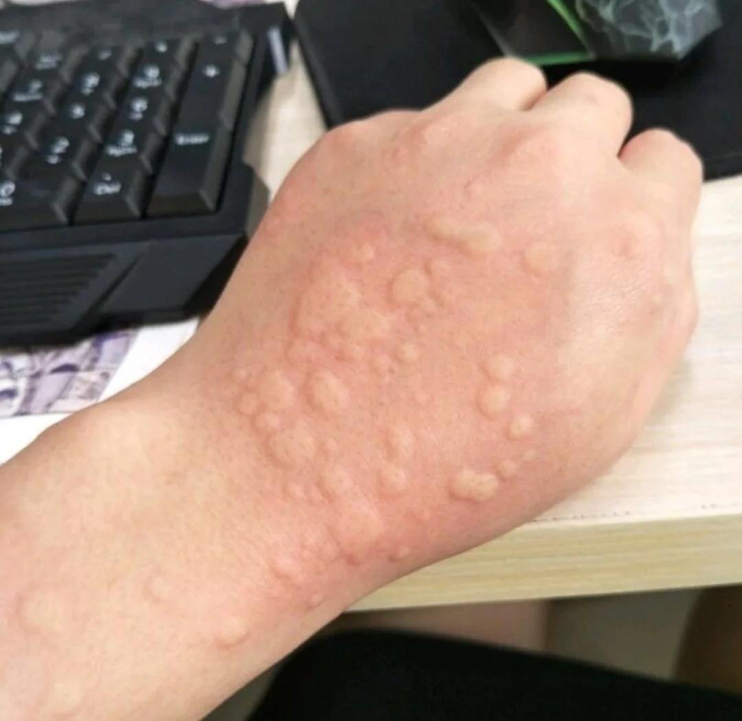 同学聚会治愈多年荨麻疹