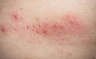 讲解过敏性荨麻疹症状与治疗方法