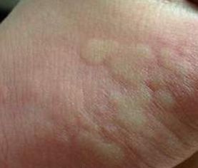 荨麻疹如何治疗呢