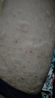 请问 我这是荨麻疹吗