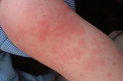 风团图片和症状图片