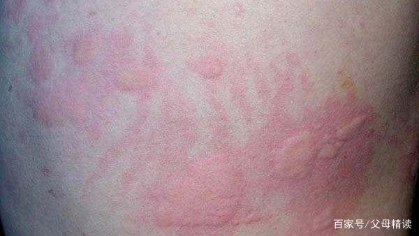 宝宝得了荨麻疹该怎么办?