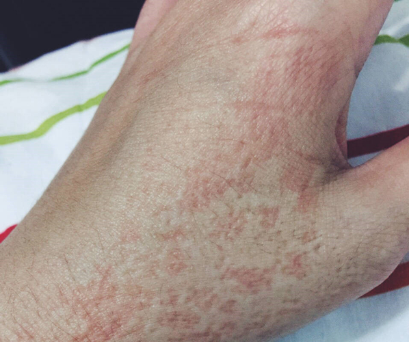 产后荨麻疹的症状图片