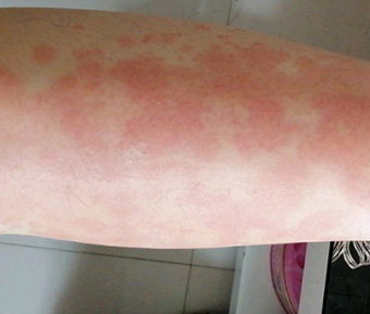 要警惕 荨麻疹的四种常见症状