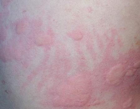 中医药膳偏方 专治过敏性荨麻疹