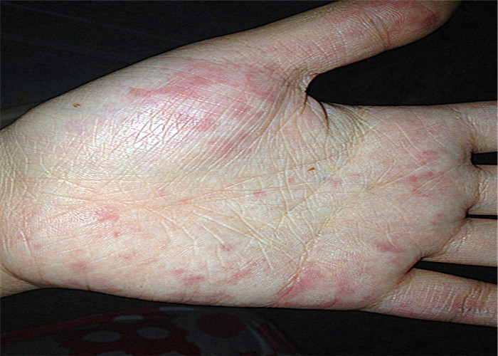 产后荨麻疹的症状图片