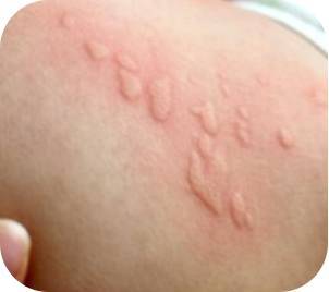你家孩子身上长过这种疙瘩吗?--宝宝荨麻疹怎么办?_母婴_网