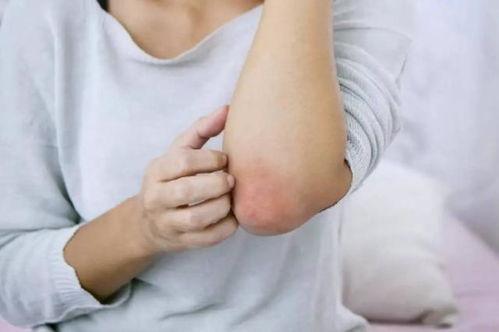 暑期湿疹多发 中医推荐这些治疗方法