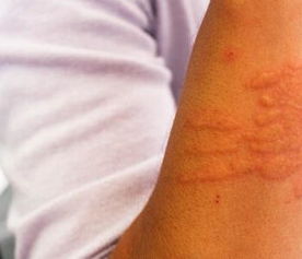 荨麻疹百科 荨麻疹医学疾病文章列表,第9页 快速问医生