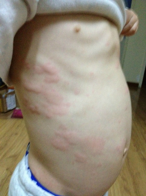 产后荨麻疹的症状图片