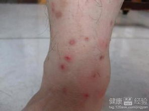 带状疱疹是怎么治疗