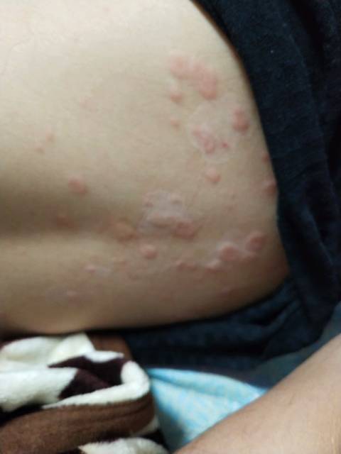 ,急性荨麻疹求止痒方法。